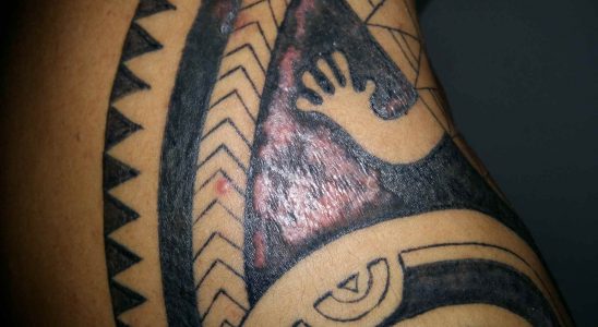 Tatouage rougeurs