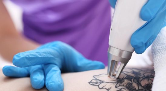 effacer un tatouage au laser