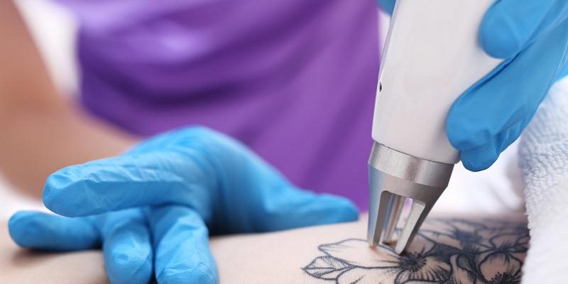 effacer un tatouage au laser