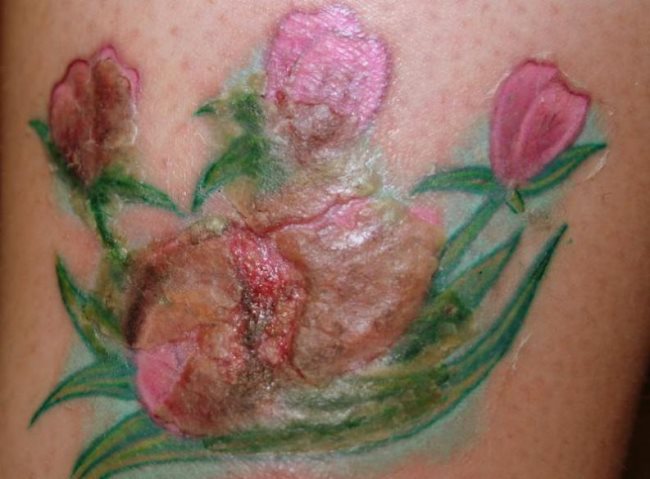 Démangeaison et infection d'un tatouage