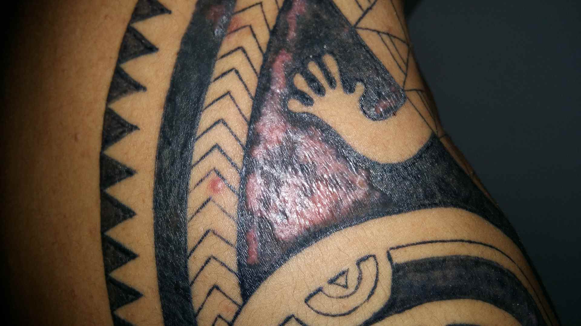 What if your tattoo itches and gets infected? Tattooneo